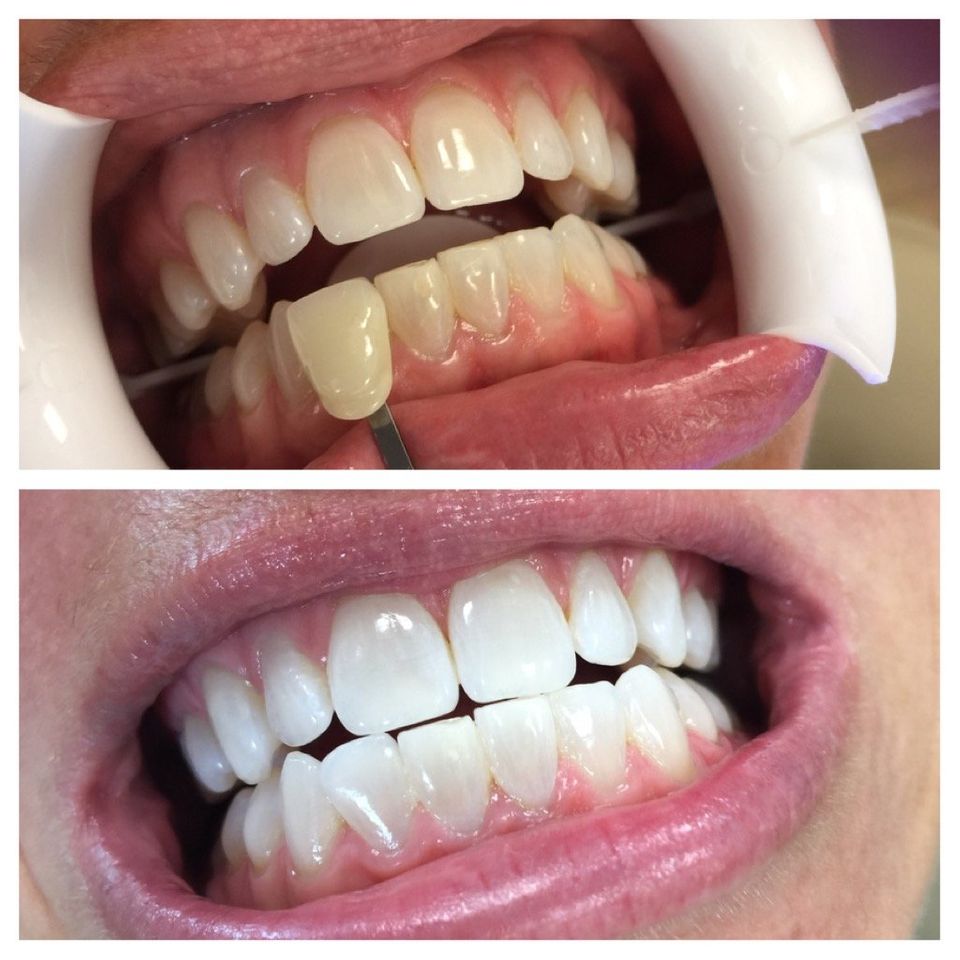 Teeth Whitening Dental Services Ap Dental Center General